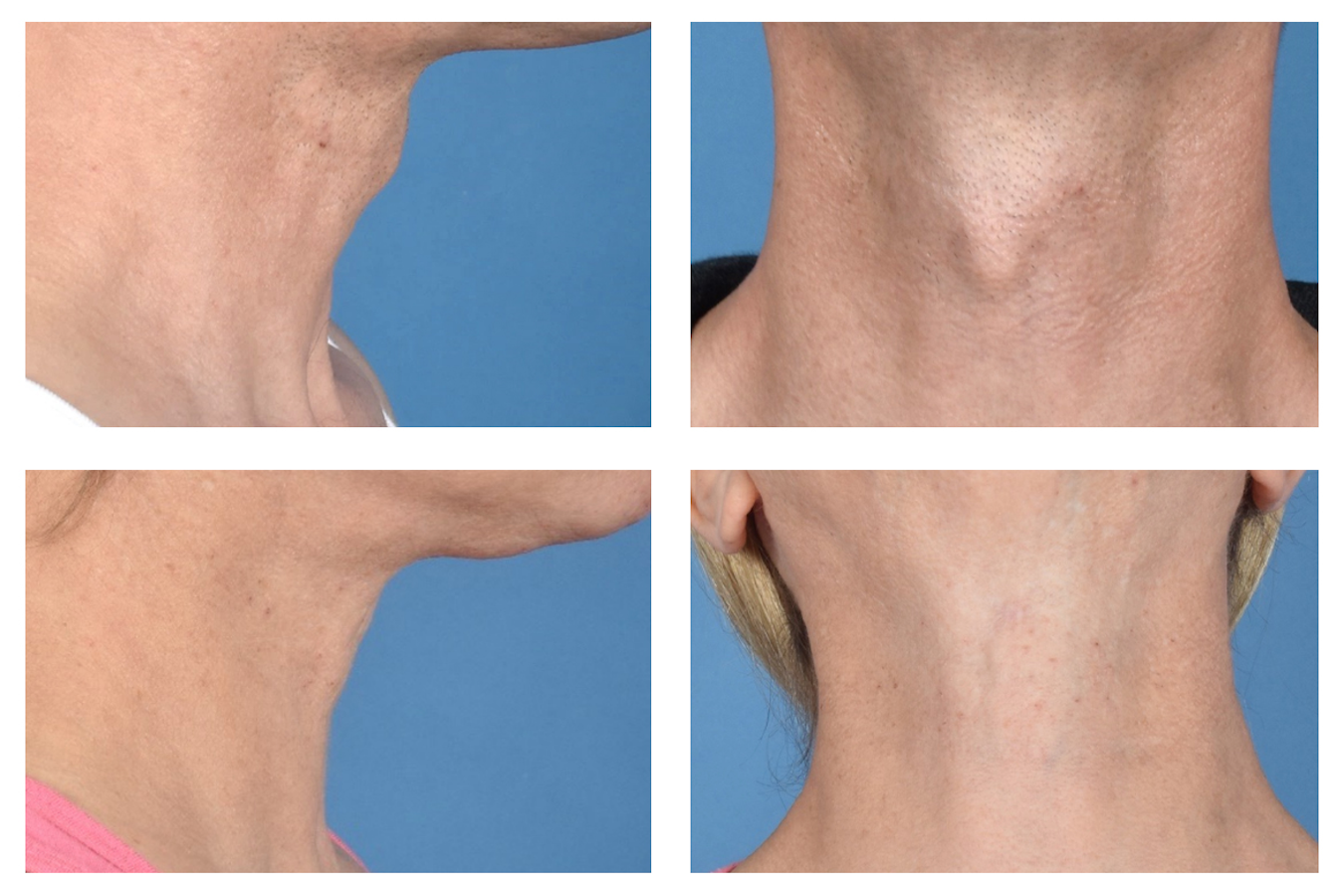 Collage showing four before-and-after photos of Adam's Apple reduction surgery