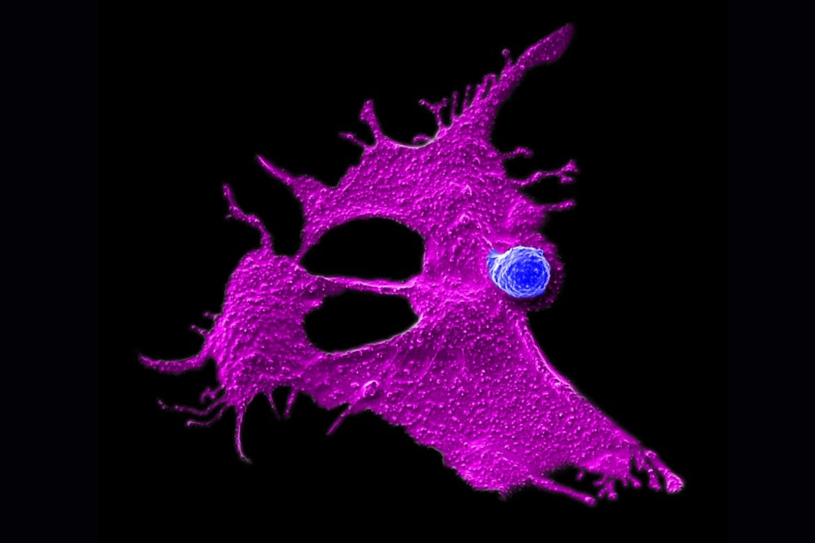 Microscopy image showing a stem cell-engineered CAR-NKT cell (blue) attacking a human solid tumor cell (magenta).