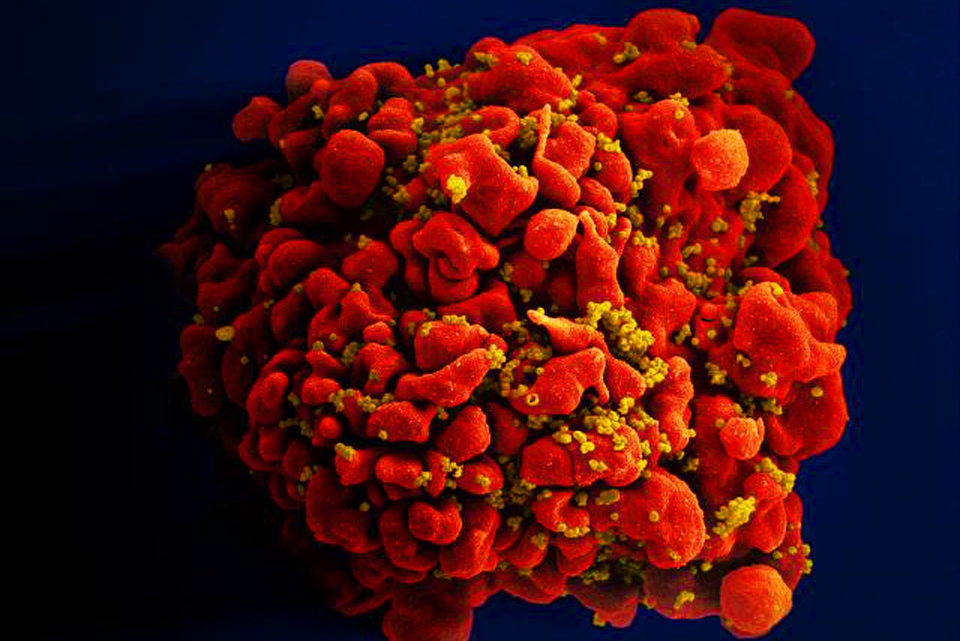 HIV infecting an immune cell