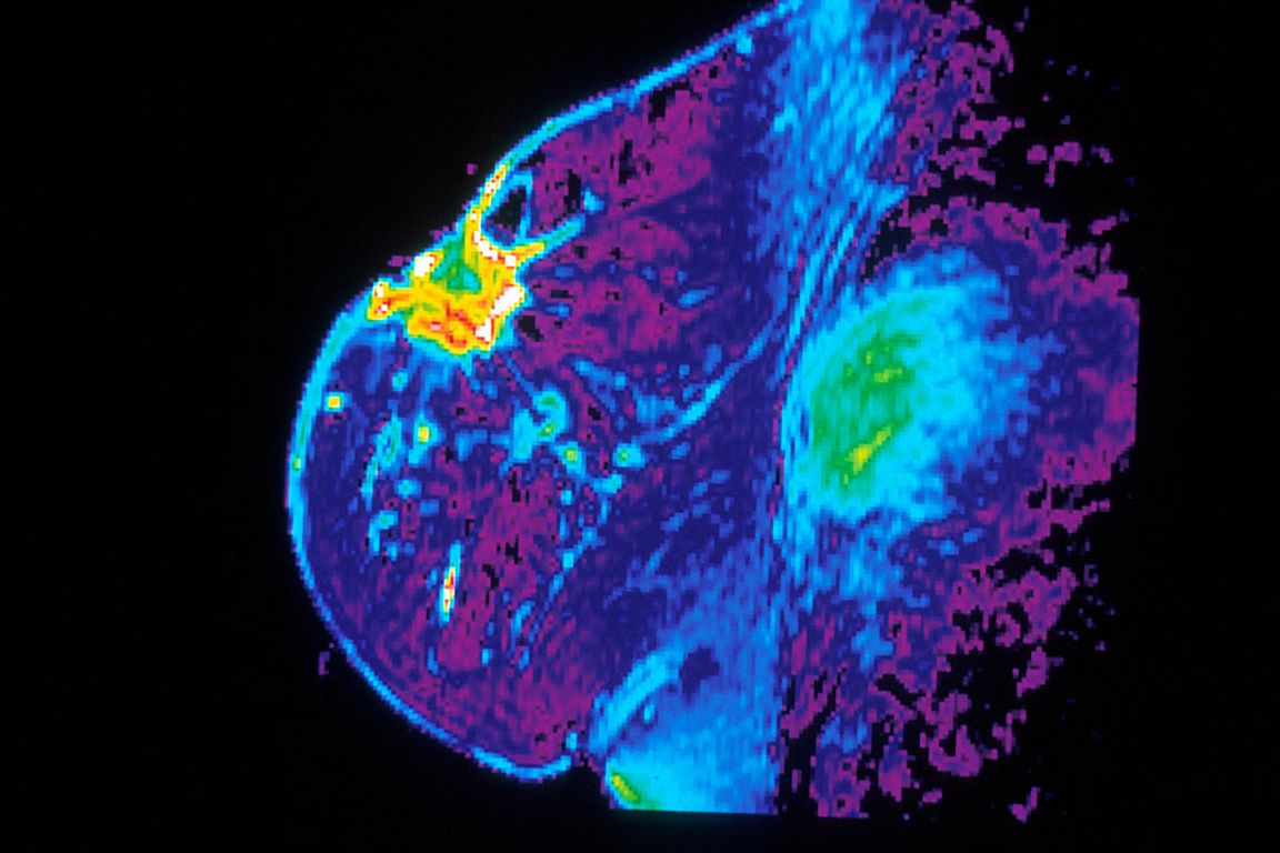An MRI image of a breast