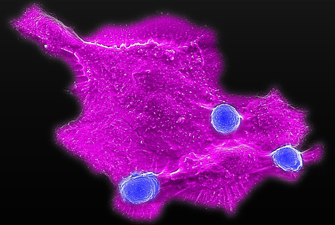 Microscopy image showing blood stem cell-engineered CAR-NKT cells (three blue dots) attacking a human solid tumor cell (magenta)
