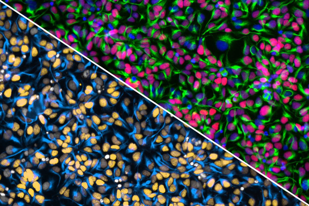 Diagonal split image showing two colorful fluorescent microscopy views of densely packed cells, with green, blue, pink and gold staining highlighting different cellular structures.